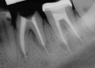 <p>Working length is important. These can affect treatment outcome</p>