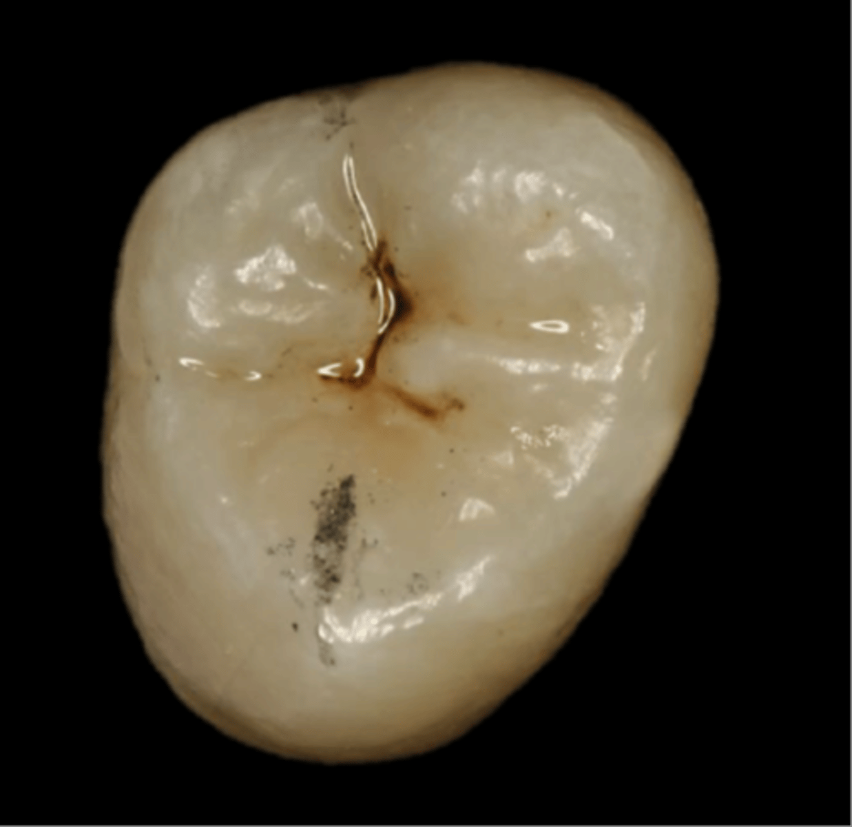 <p>a fault occuring along a developmental groove caused by incomplete joining of the lobes</p>