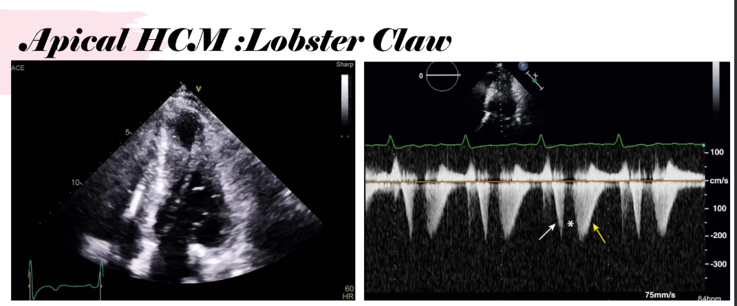 <p>Mid cavitary obstruction: The emptying profile has an initial <strong>rapid emptying</strong> of the pouch in early systole, followed by a <strong>signal void</strong> in mid-to-late systole because flow stops/ cessation of flow as the neck narrows during contraction obstructing flow. Then follwed by a second outflow in <strong>diastole</strong> from incompletely emptied pouch.</p><p>(Diastolic emptying of Apical Aneurysm) ( Blue berry on top)</p><p></p><p></p><p>The <strong>“second outflow in diastole”</strong> means the <strong>apical pouch did not fully empty during systole</strong>, so some blood is still trapped/left over in that pouch. Then, when the heart relaxes in <strong>diastole</strong>, that leftover blood moves out again.</p><p>the <strong>third signal</strong> is basically showing the leftover blood trying to empty after the obstruction relaxes. The slide describes this as an initial rapid emptying, then cessation of flow when the neck narrows, then a second outflow in diastole from the incompletely emptied pouch.</p>
