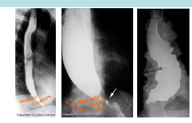 <p><span>Radiologisch beeld.</span></p><p style="text-align: left;"></p><p style="text-align: left;"><span>Naarmate druk in slokdarm langer duurt zien we een uitzetting van de slokdarm.</span></p><p style="text-align: left;"></p><p style="text-align: left;"><span>We hebben geen / weinig passage.</span></p><p style="text-align: left;"></p><p style="text-align: left;"><span>Bij type III:</span></p><p><span>Ongecoördineerde contracties die optreden.</span></p>