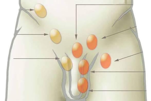 <p>Afección congénita en la que uno o ambos testículos no descienden desde el abdomen. </p>