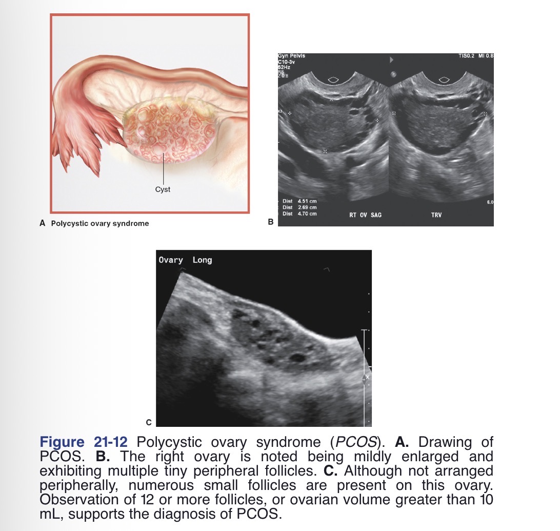 <p>“String of pearls” sign or “necklace” sign: many small follicles along periphery </p><p>Bilateral enlargement of the ovaries</p><p>Increased stroma and increased stromal echogenicity</p><p>One or both ovaries should contain 12 or more follicles that measure between 2 and 9 mm in diameter</p><p>Ovarian volume greater than 10 mL</p><p>Threshold of 25 small follicles can also be used</p>