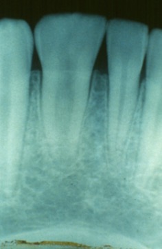 <p>Two tooth buds fused together</p><p></p><p>-2 roots, one crown</p>