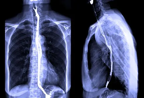 <p>Posterior ( behind) the trachea</p>