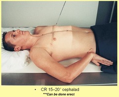 <p>Projects clavicles superiorly to demonstrate the apices</p><p>CR 15 to 20° cephalad to midsternum</p><p>Elevate chin to avoid superimposition with apices</p><p>roll shoulders forward if possible</p>