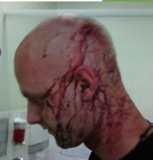 <p><span style="font-family: "Wingdings 3";">}</span><span style="font-family: "Trebuchet MS";">An open head injury occurs when an individual receives an impact from an outside force severe enough to cause to fracture or displace the skull.</span></p><p><span style="font-family: "Wingdings 3";">}</span><span style="font-family: "Trebuchet MS";">Positives: More room for swelling decreases risk of secondary compression injury</span></p><p><span style="font-family: "Wingdings 3";">}</span><span style="font-family: "Trebuchet MS";">Negatives: The brain is exposed and vulnerable to infections and/or further injury.</span></p><p><span style="font-family: "Wingdings 3";">}</span><span style="font-family: "Trebuchet MS";">If the skull is fractured or displaced, bone fragments from the skull can enter the brain and cause further injury.</span></p>