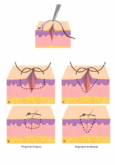<p>-needle enters skin with a 1/4-inch bite from the wound edge at 90 degrees</p><p>-use the forceps and lightly grasp the skin edge and arc the needle through the opposite edge inside the wound edge taking equal bites</p><p>-rotate writs to follow arc of the needle</p><p>-principle: minimize trauma to the skin, don’t bend the needle, follow path of least resistance</p><p>-evert wound edges, scars contract over time</p>