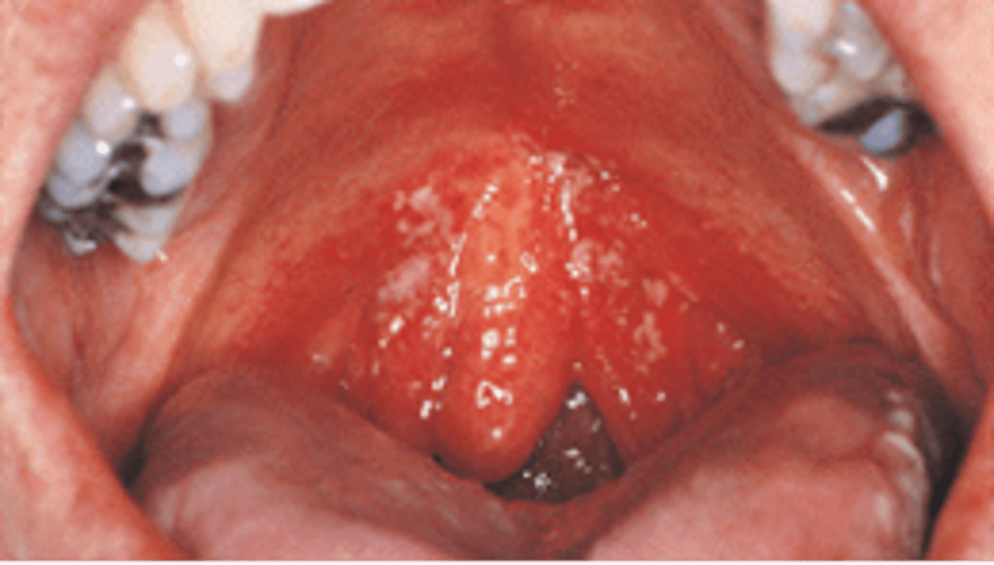 <p><br>Thick, white, raised patches in the mouth</p><p><br></p><p>This condition most commonly appears in patients with HIV. What is the clinical diagnosis?</p>