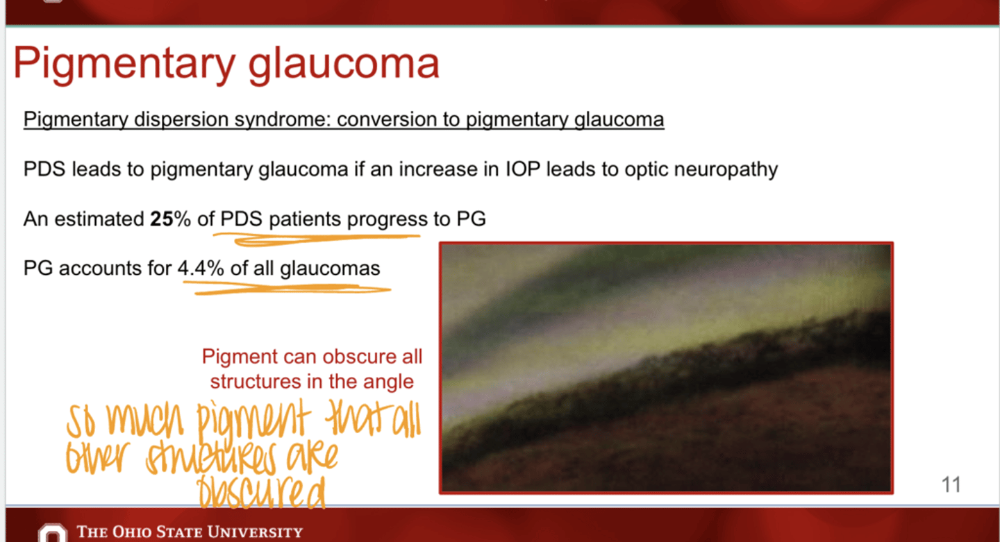<p>PDS leads to pigmentary glaucoma if an increase in IOP leads to what?</p>