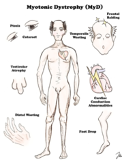 <p>Symptoms begin in adulthood</p><p>- Progressive muscle wasting/weakness</p><p>- Prolonged muscle contractions; unable to relax muscles, cannot release grip, locking of jaw </p><p>- Long, narrow face with hollowed cheeks, frontal balding</p><p>- Hypogonadism (↓Test, ↑FSH)</p><p>- Cardiac Arrhythmia</p><p>- Cataracts at young age</p>