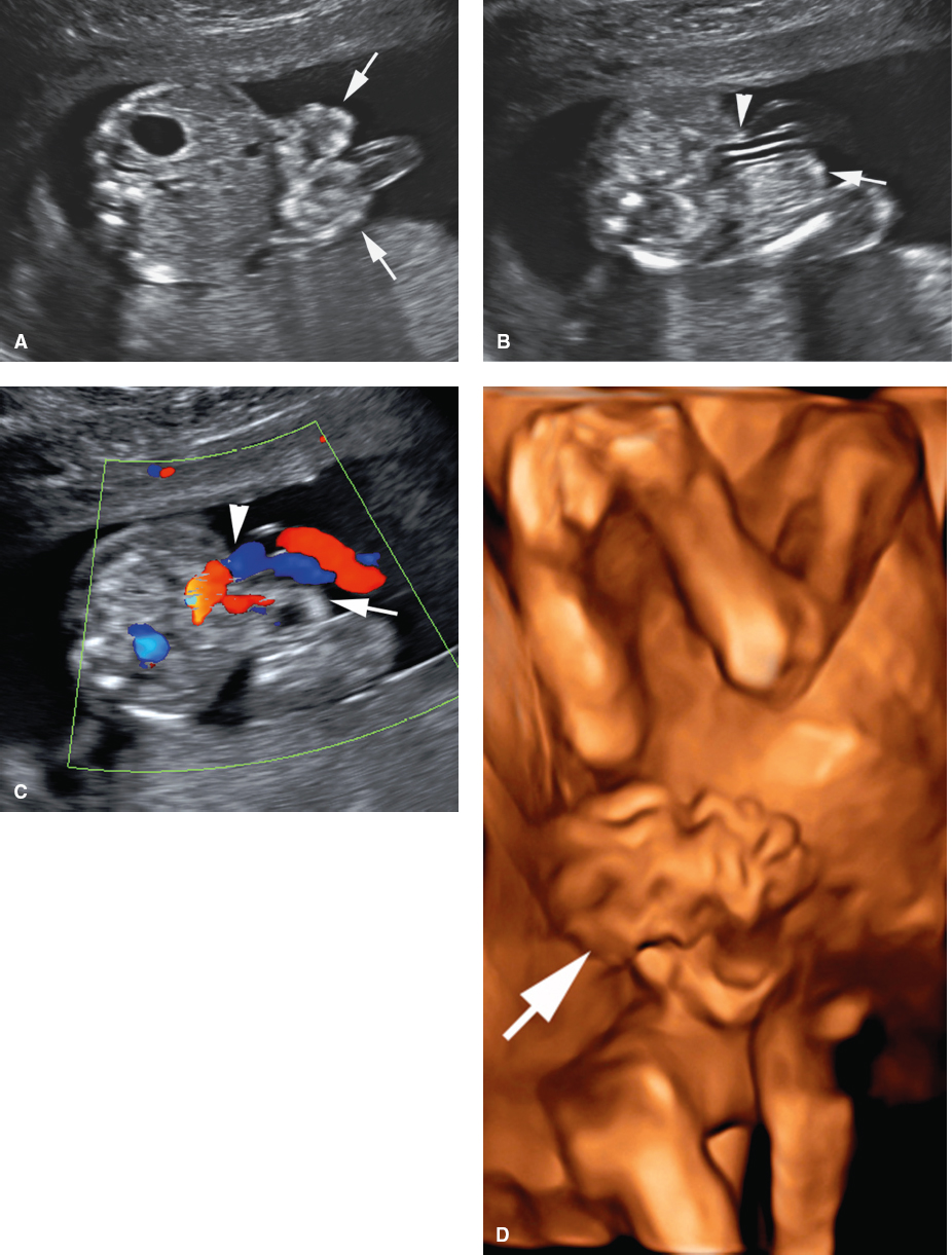<p>Normal cord insertion</p><p>Periumbilical, right-sided mass</p><p>Recognizable loops of bowel outside the abdomen</p><p>Intrauterine growth restriction</p>