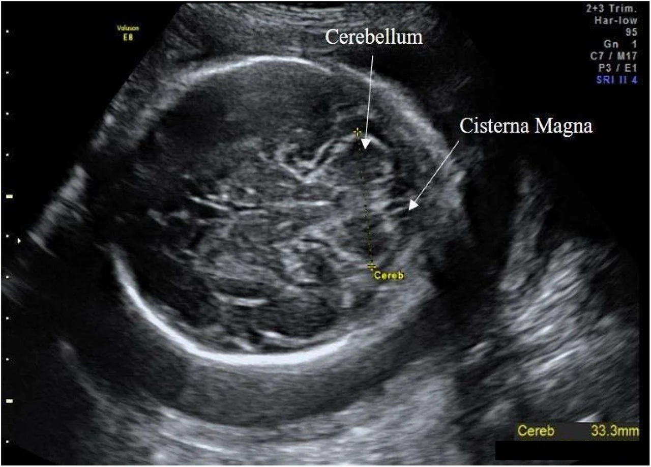 <p>2 lobes joined together by cerebellar vermis </p>