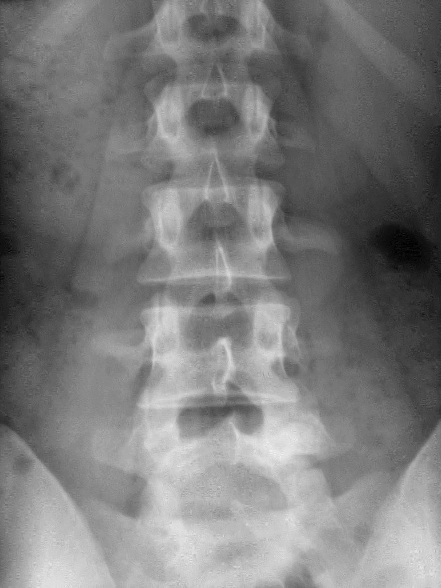 <p>What is the DDx for a dense pedicle/pars/lamina redion?</p>