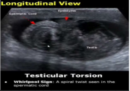 <p>Testicular Torsion</p>