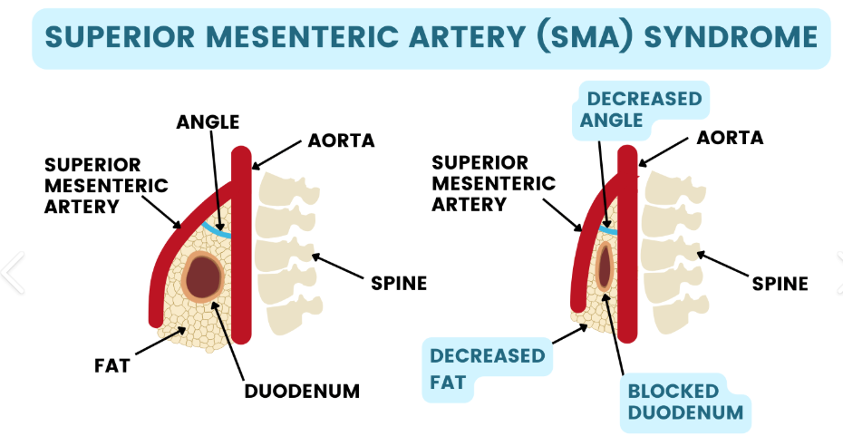 <ol><li><p><span style="color: rgb(67, 113, 177);"><strong>breathing difficulties</strong></span></p></li></ol><ul><li><p>can compress lungs</p></li></ul><ol start="2"><li><p><span style="color: rgb(219, 73, 215);"><strong>low self esteem</strong></span></p></li></ol><ol start="3"><li><p><span style="color: rgb(55, 180, 186);"><strong>superior mesenteric artery syndrome</strong></span></p></li></ol><ul><li><p>compression of the duodenum by the <strong>aorta and superior mesenteric artery</strong>, leading to obstruction.</p><ul><li><p>“squeezes intestines”</p></li></ul></li></ul><p></p><p>postop complications: (6)</p><ol><li><p><span style="color: rgb(227, 126, 126);"><strong>Spinal cord </strong>or neuro<strong> injury</strong></span></p></li><li><p><span style="color: rgb(167, 122, 17);"><strong>Pneumothorax </strong>(decreased mobility)</span></p></li><li><p><span style="color: rgb(167, 122, 17);"><strong>Atelectasis </strong>(decreased mobility)</span></p></li><li><p><span style="color: rgb(167, 122, 17);"><strong>Ileus </strong>(decreased mobility)</span></p></li><li><p><span style="color: rgb(34, 145, 216);"><strong>Hypotension </strong>(blood loss)</span></p></li><li><p><span style="color: rgb(239, 32, 170);"><strong>Infection </strong></span>(wound)</p></li></ol><p></p>