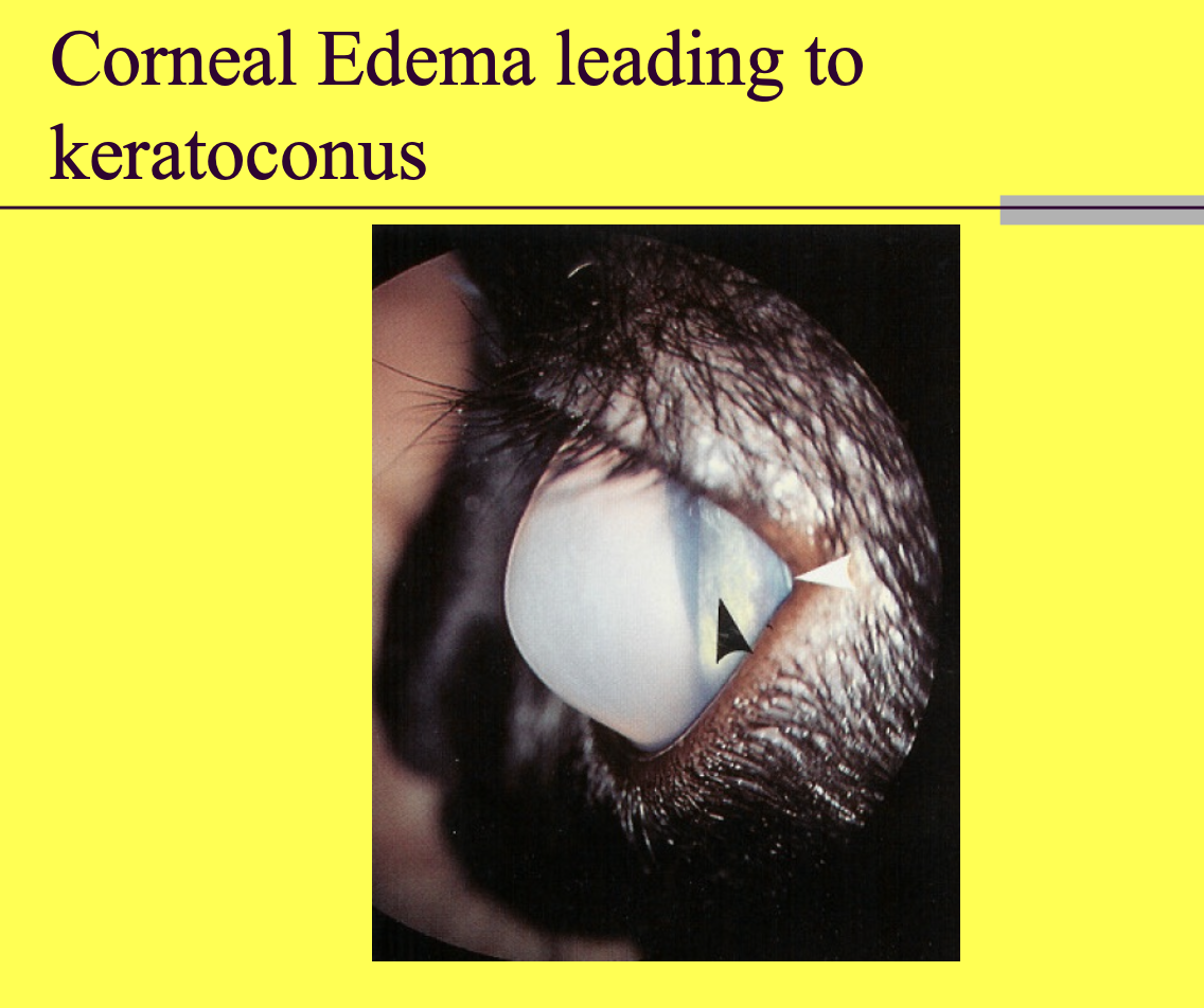<p>keratoconus</p>