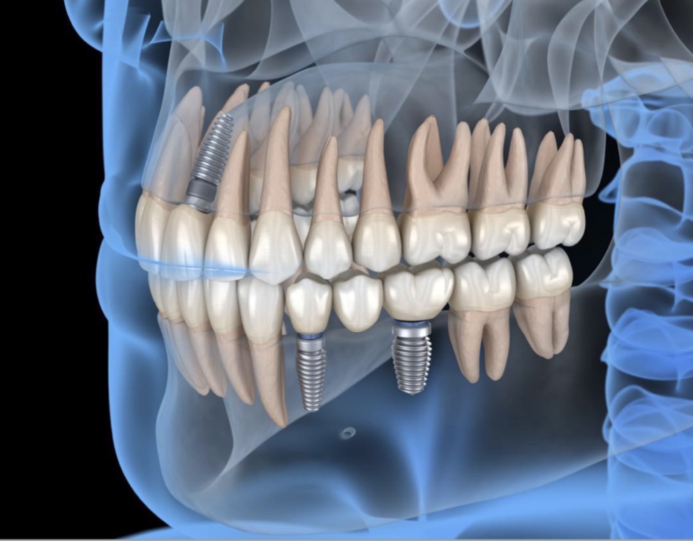 <p>What dental specialty is being displayed here?</p>