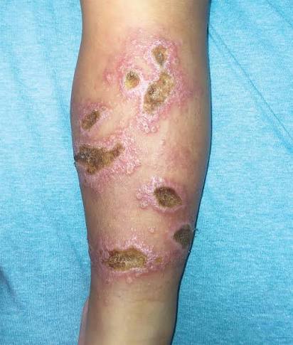 <p>Leishmaniasis</p>