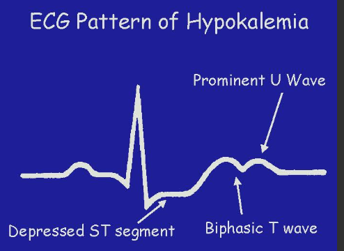 <p>U waves, QT prolongation </p>