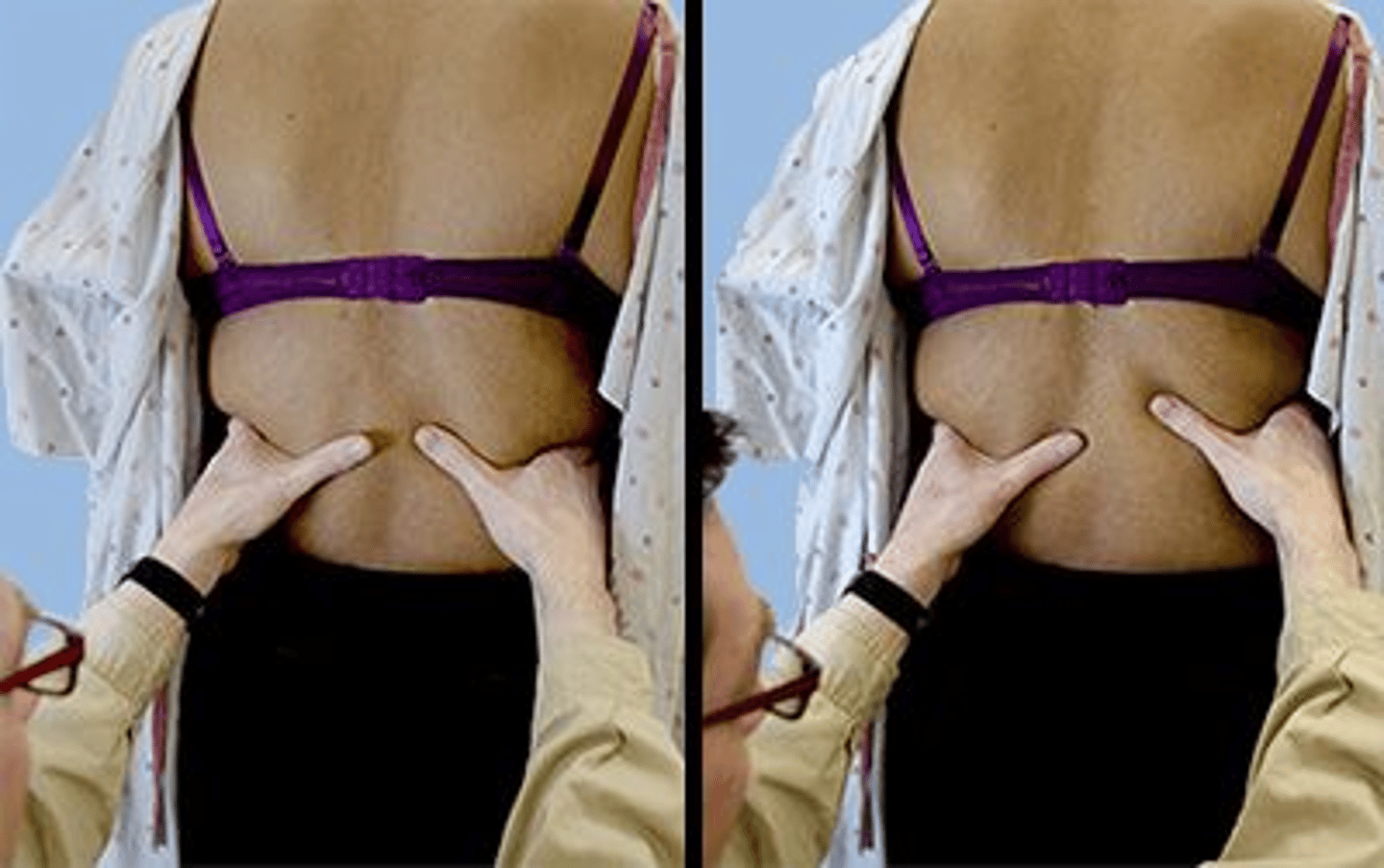 <p>2,2</p><p>1. The image shows the technique for palpating the lower lobes. To assess the right middle lobe and lingular segment, the therapist places his/her widely outstretched fingers of both hands over the posterior axillary folds and his/her palms over the anterior chest wall.</p><p>2. The image clearly shows the technique for palpating the lower lobes. The therapist's thumbs and hands do not move the same distance from each other, indicating restriction on the left side. With unilateral restriction, there is evidence of diminished movement on only one side.</p><p>3. The image clearly shows the technique for palpating the lower lobes. The therapist's thumbs and hands do not move the same distance from each other, indicating restriction on the left side and not the right side. With unilateral restriction, there is evidence of diminished movement on only one side.</p><p>4. The image clearly shows the technique for palpating the lower lobes. To assess the upper lobes, the therapist places his/her palms anteriorly over the first four ribs with the fingertips extended over the trapezius muscle.</p>