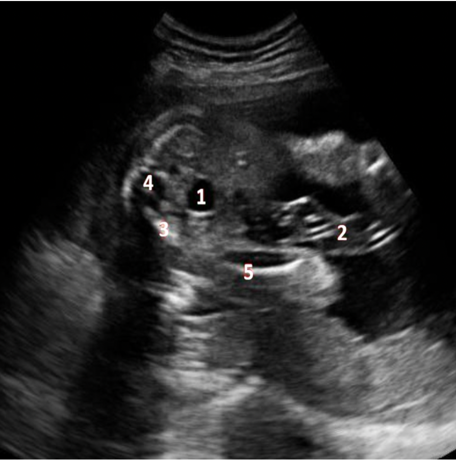 <p>What fetal structure is indicated by #4?</p><p>A. sacral spine</p><p class="p1">B. cord</p><p class="p1">C. lumbar spine</p><p class="p1">D. pelvic bone</p>