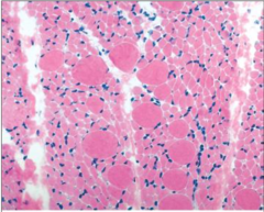 <p>defined by progressive degeneration of anterior horn cells</p>