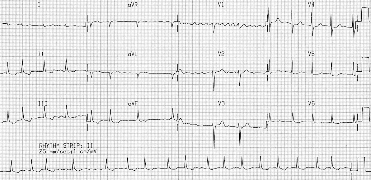 <p>In a stable patient with this EKG, what should be done? </p>