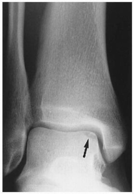 <p></p><ul><li><p>Will either see no swelling or delayed swelling</p><ul><li><p>This is indicative of an articular cartilage injury</p></li></ul></li><li><p>Shear Forces and Compression Forces are painful</p></li><li><p>Patient may report a "catching" or something "stopping" their ROM</p></li><li><p>Pain with palpation over areas of articular cartilage</p></li></ul><p></p>