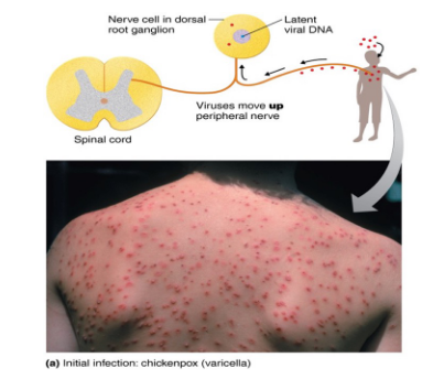 <ul><li><p><span style="font-size: calc(var(--scale-factor)*12.00px);">Herpesvirus varicella-zoster (human herpesvirus 3)</span></p></li><li><p><span style="font-size: calc(var(--scale-factor)*12.00px);">Transmitted via the respiratory route</span></p></li><li><p><span style="font-size: calc(var(--scale-factor)*12.00px);">Causes pus-filled vesicles after a 10–14 day</span><br><span style="font-size: calc(var(--scale-factor)*12.00px);">incubation</span></p></li></ul><p></p>