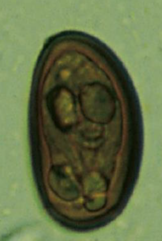 <p>Diagnosis this trematode infection passed on this egg morphology</p>