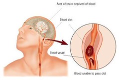 <p>cerebral vascular accident</p>