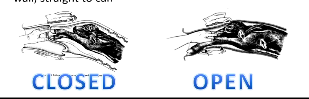 <p><strong>Q1 Is she calving? - is the cervix open or closed?</strong></p><p>(see uterine torsion)</p><p>• Closed = Feel closed cervix/calf through uterine wall</p><p>• Half open = Feel ring</p><p>• Open = don't feel cervix at all, merges into vaginal wall, straight to calf</p><p><strong>Q2 what have I got......?</strong></p><ul><li><p>E.g. (legs, back legs, head, etc.)</p></li></ul><p><strong>Q3 Do I have front legs or back legs?</strong></p><p>• Head/hock/tail are obvious landmarks</p><p>• Can bend joints and see if bend in same or different directions</p><p><strong>Q4 Is calf dead or alive?</strong></p><p>• Pinch toe</p><p>• Fingers to back of mouth to test gag reflex</p><p>• Poke eye</p><p>• Anal reflex</p><p>• Feel heart/pulse</p><p><strong>If dead - how dead?</strong></p><p>A calf dead for a while would be - smelly, emphysematous and disintegrate</p><ul><li><p>If alive - don't over commit this information to the farmer</p></li></ul><p><strong>Q5 Can I deliver this calf per vagina........?</strong></p><p>Should be ok if…</p><p>• Head comes into canal itself and stays there without being pulled</p><p>• Hand passes over head and shoulders when calf in pelvis</p><p>• Feet out 10cm beyond cow</p><p>• Pull from one person plus a push from the cow brings calf into pelvis</p><p>• One person pulls one leg to bring shoulder into canal, hold it there while the other person pulls the second leg</p><p><mark data-color="#e1cbcb" style="background-color: rgb(225, 203, 203); color: inherit;">Warning signs.....</mark></p><p><mark data-color="#e1cbcb" style="background-color: rgb(225, 203, 203); color: inherit;">• Feet crossing, feet rotating inwards, no progress (water bag delayed)</mark></p><p><mark data-color="#e1cbcb" style="background-color: rgb(225, 203, 203); color: inherit;">• Experience has a huge influence on this - very difficult to teach......</mark></p>