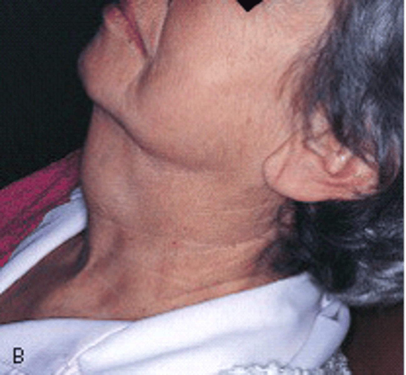<p><br>a palpable cystic midline mass in the neck due to incomplete closure of the thyroglossal duct.</p><p><span>The enlargement on the midline of this patient's neck has been present for months and is slowly increasing in size. It is soft and painless.Histologic examination shows this to be an epithelium-lined sac filled with clear, yellow fluid. What type of cyst is it?</span></p>