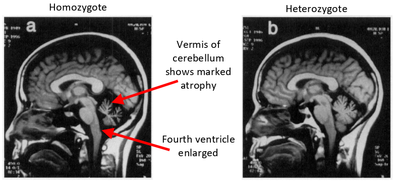 <p>-autosomal dominant (expanded CAG repeat in chromosome 6 containing SCA1 locus)</p><p>-cAG repeat size correlated with siza and age of onset</p><p>-neurodegeneration of cerebellum, spinal cord &amp; brain stem</p>