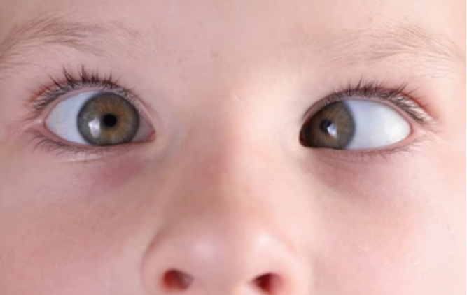 <p>Strabismus </p>