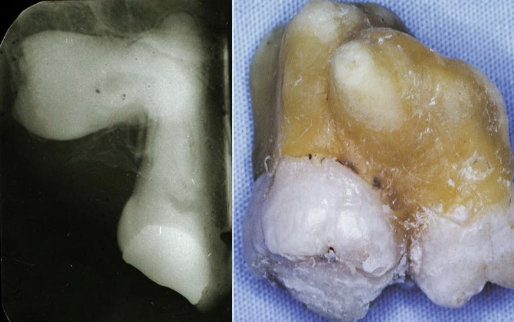 <p>union of two teeth by cementum alone </p>