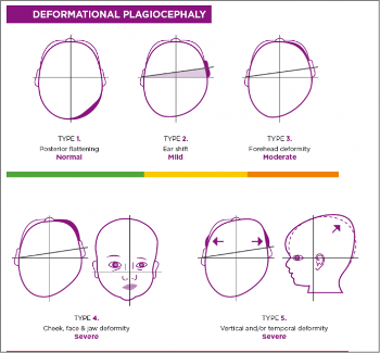 <p><strong>Argenta Classification</strong></p><p></p><ul><li><p><strong>1 - Normal Head Shape</strong></p><ul><li><p>1 Quadrant Impacted</p></li><li><p>Mild Posterior Flattening</p></li></ul></li></ul><p></p><ul><li><p><strong>2 - Mild Deformity</strong></p><ul><li><p>2 Quadrants Impacted</p></li><li><p>“1” + IPSI Anterior Ear Shift</p></li></ul></li></ul><p></p><ul><li><p><strong>3 - Moderate Deformity</strong></p><ul><li><p>2 Quadrants Impacted</p></li><li><p>“2” + IPSI Forehead Prominence</p></li></ul></li></ul><p></p><ul><li><p><strong>4 - Severe Deformity</strong></p><ul><li><p>2 Quadrants Impacted</p></li><li><p>“3” + Face-Jaw Asymmetry</p></li></ul></li></ul><p></p><ul><li><p><strong>5 - Very Severe Deformity</strong></p><ul><li><p>≥ 3 Quadrants Impacted</p></li><li><p>“4” + Vertical / Temporal</p></li></ul></li></ul><p></p>