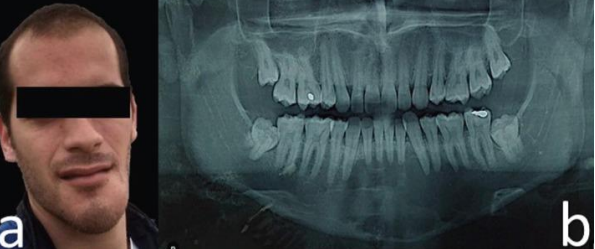 <p>A 20 year old boy presented with swelling of the lower face. Provide DD</p>