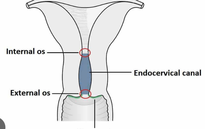 <ul><li><p>0.5mg in a 2.5 mL syringe</p></li><li><p>bring gel to room temp, but do not force warming (can inactivate drug)</p></li><li><p>mom is in supine position with a lateral tilt, or side lying position for 30 min after insertion </p></li><li><p>attached to catheter inserted into the cervical canal just below internal cervical os.</p></li><li><p>dose may be repeated q6 hrs PRN for cervial ripening</p></li><li><p>max dose of 1.5mg (3 doses) in a 24hr period</p></li><li><p>administer in or near brith unit</p></li><li><p>cant be effectively removed if adverse effects occur</p></li></ul><p></p>