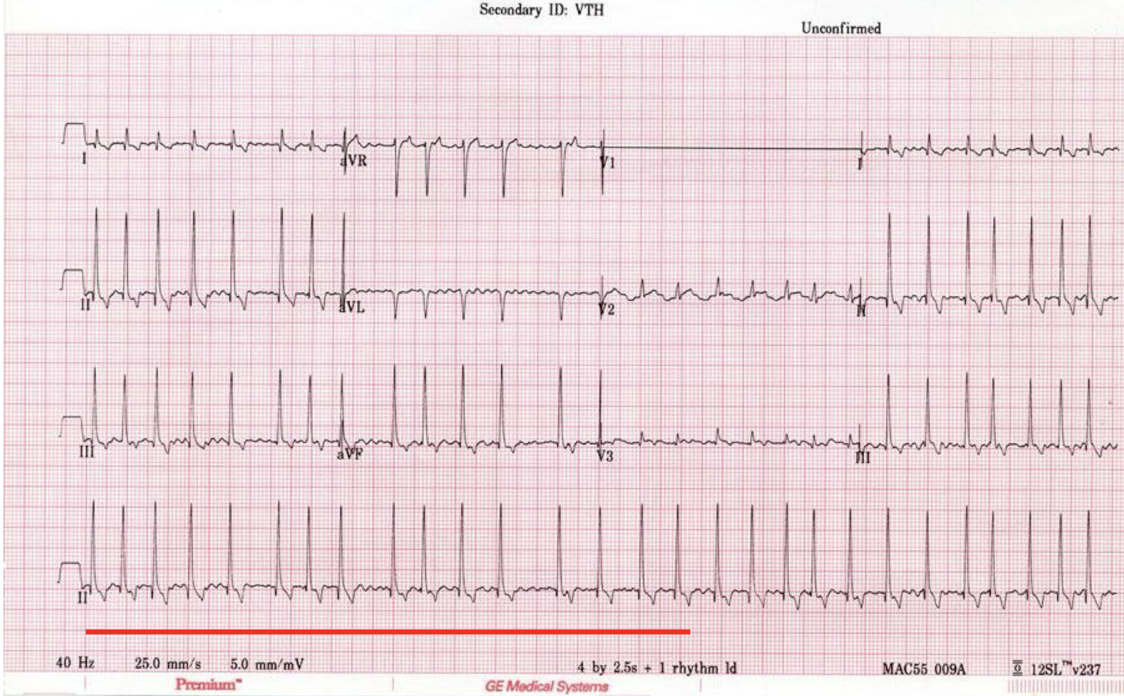 <ul><li><p>absence of P waves</p></li><li><p>irregular rhythm</p></li><li><p>tachycardia</p></li><li><p>± f waves</p></li><li><p>narrow QRS complexes</p></li></ul><p></p>