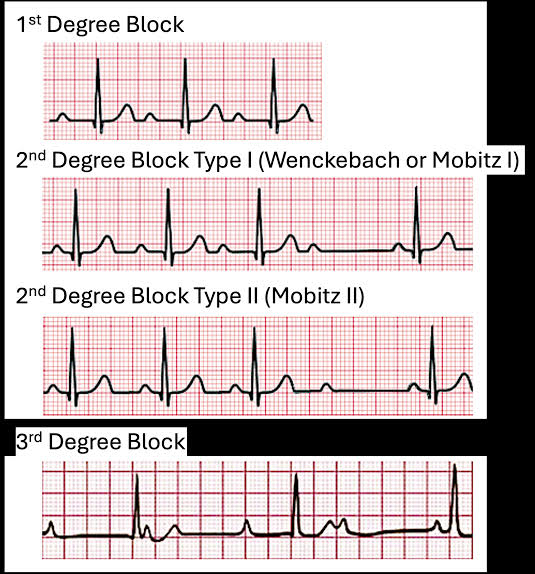 <p> type I (Mobitz I) second degree AV block</p><p><sub>“think going,,, going,, drop” </sub></p>