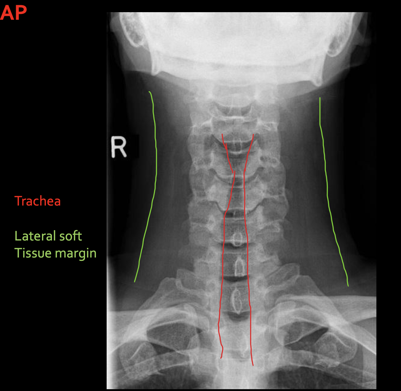 <p><span>Trachea</span></p>