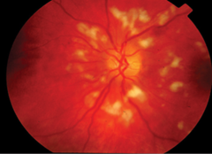 <p>white/gray ovoid lesions with soft borders</p>