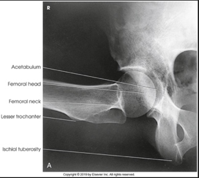 <p>How do you know this is a lateral Lauenstein</p>