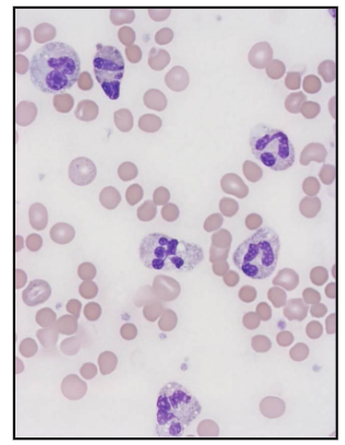 <p>Bacterial Infections</p>