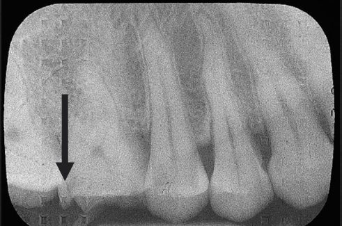 <p>What is the herringbone pattern?</p>