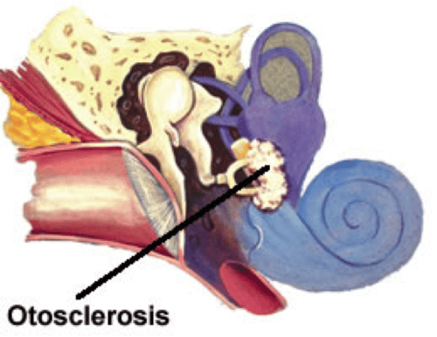 <p>genetic abnormal overgrowth of bone conductive hearing loss. It can be treated with surgery.</p>