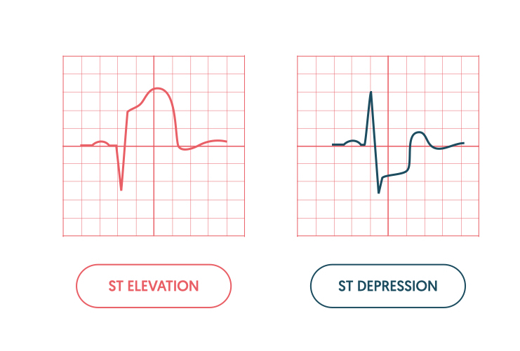 <p>What 2 pathologies are shown on the ECG? What is the difference between them?</p>