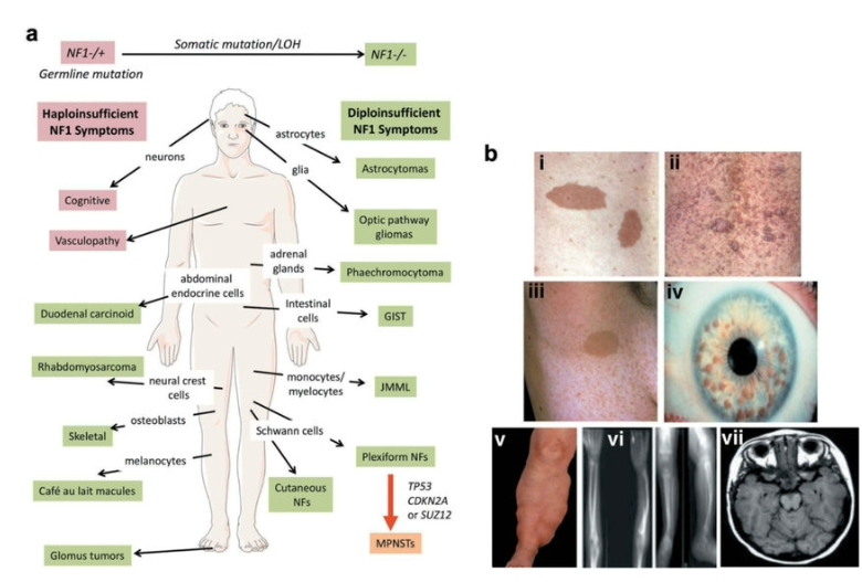 <p>Neurofibromatosis type 1 (NF1)</p><p>MISSENSE AD Loss Of Function (LOF)</p><p>one of the most common AD genetic conditions</p>