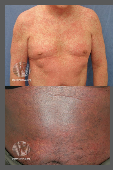 <p>Usually first appears on the trunk and then spreads to the limbs and neck</p><p>Distribution is bilateral and symmetrical maculopapular rash</p><p>Discrete lesions may merge together to form large patches or plaques</p><p>May be associated with a mild fever and itch. As it improves, the redness dies away and the surface skin peels off.</p>